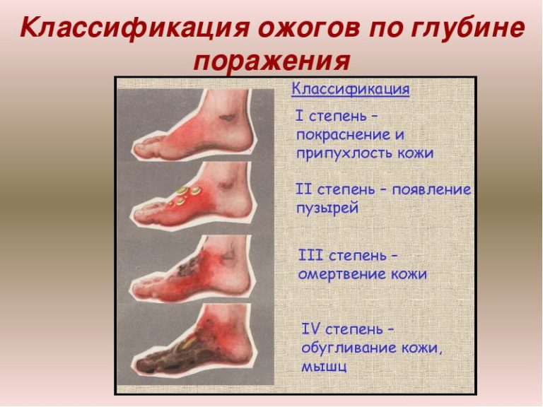 Что делать при ожоге на ноге в домашних условиях Что делать при ожоге на ноге в домашних условиях