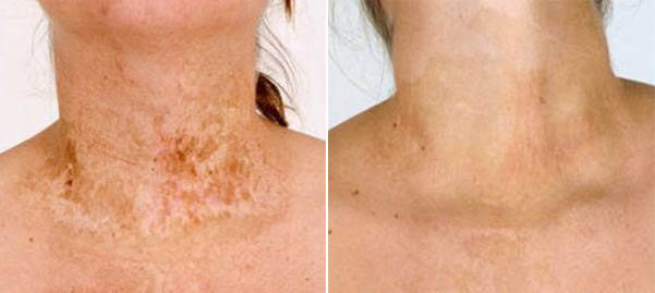 Пересадка кожи после ожога - до и после