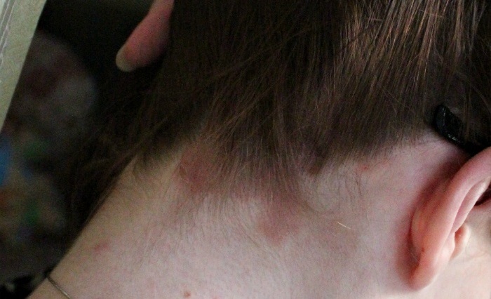 Ожог кожи головы после окрашивания волос