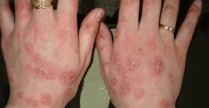 Аллергия на мыльную пену