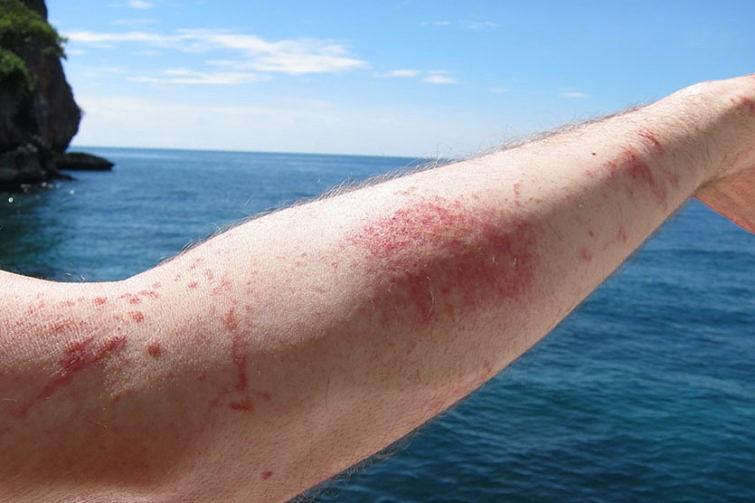 Воздействие опасных водорослей на кожу
